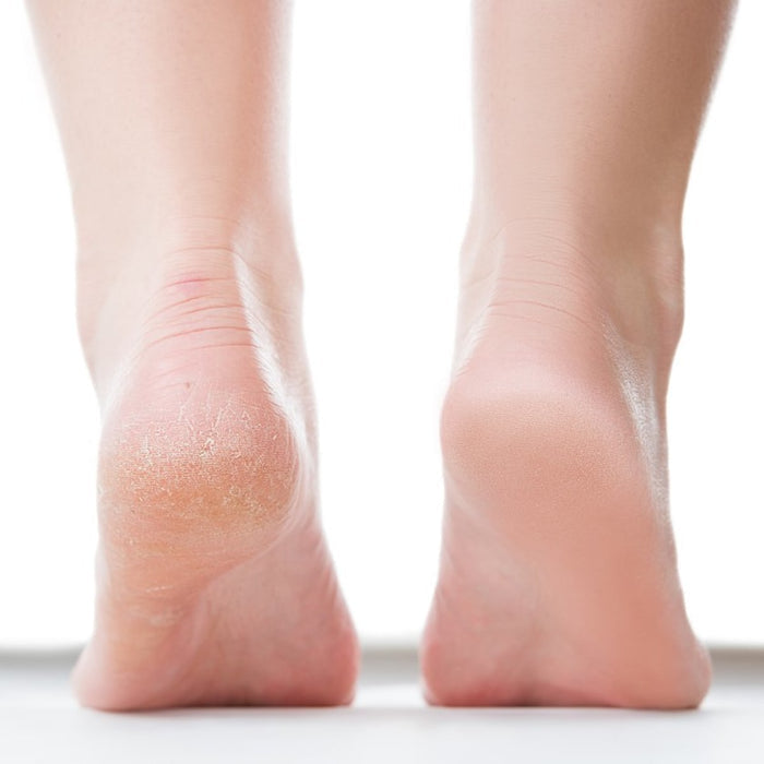 i-Spa Heel Peel Course | Correspondence with kit